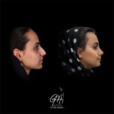 rhinoplasty-14