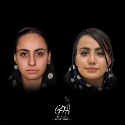 rhinoplasty-15