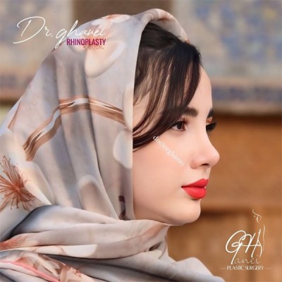 rhinoplasty-16