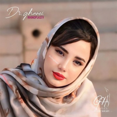 rhinoplasty-17