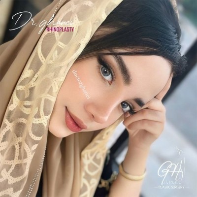 rhinoplasty-18