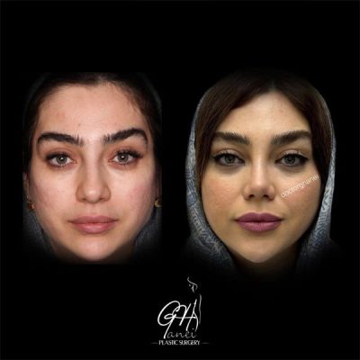 rhinoplasty-20
