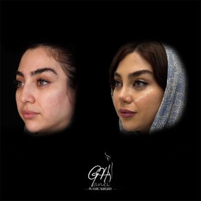 rhinoplasty-21
