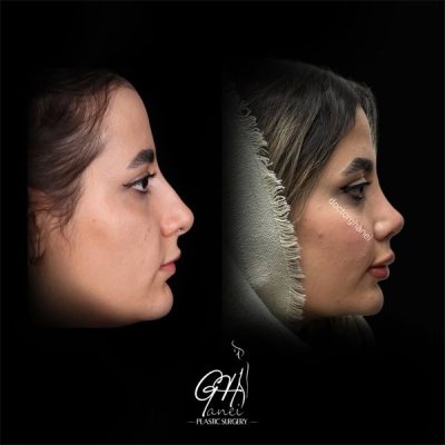 rhinoplasty-22