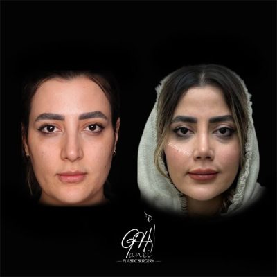 rhinoplasty-24
