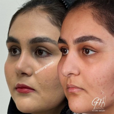 rhinoplasty-25