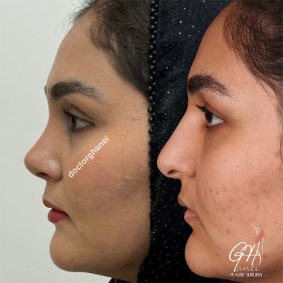 rhinoplasty-26