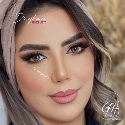 rhinoplasty-27