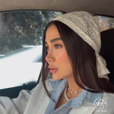 rhinoplasty-30