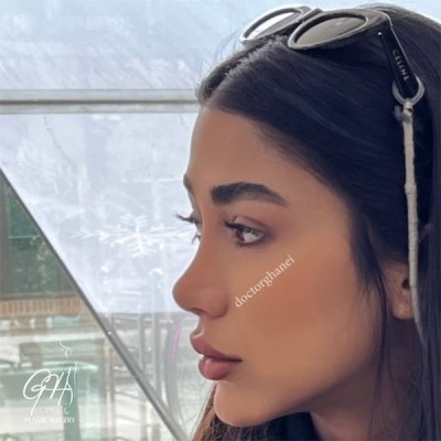 rhinoplasty-32