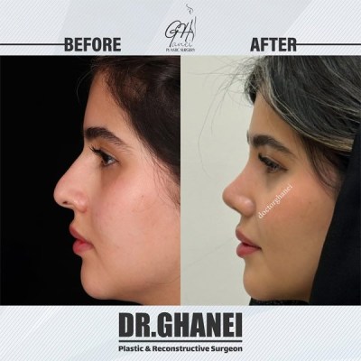 rhinoplasty-39