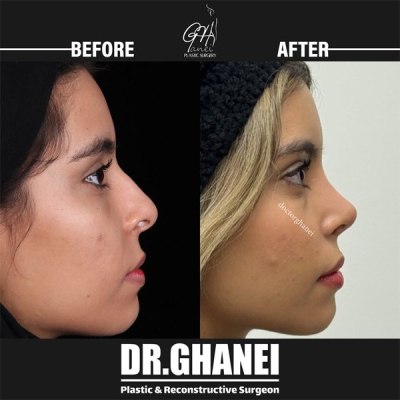 rhinoplasty-40
