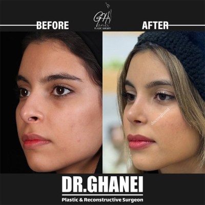 rhinoplasty-41