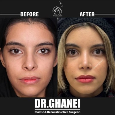rhinoplasty-42