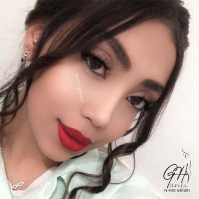 rhinoplasty-43