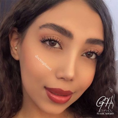 rhinoplasty-44