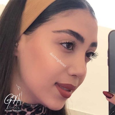 rhinoplasty-45