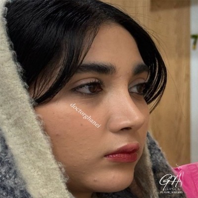 rhinoplasty-46