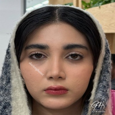 rhinoplasty-47