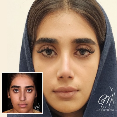 rhinoplasty-before-after-1