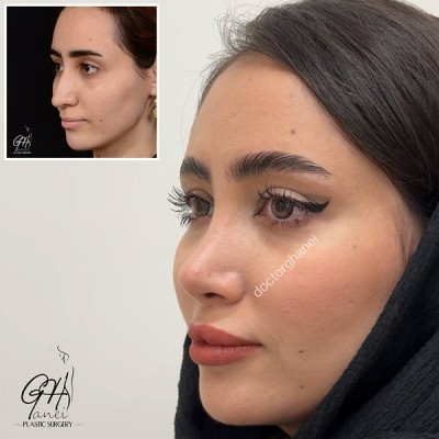rhinoplasty-before-after-10