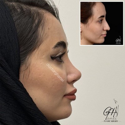 rhinoplasty-before-after-11