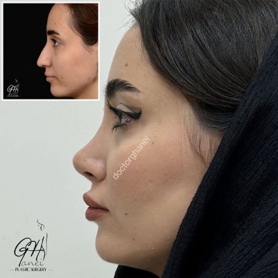 rhinoplasty-before-after-12