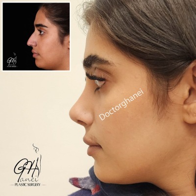 rhinoplasty-before-after-2