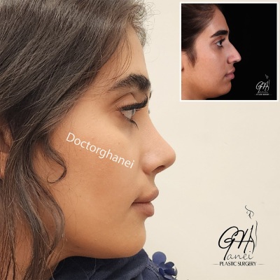 rhinoplasty-before-after-3