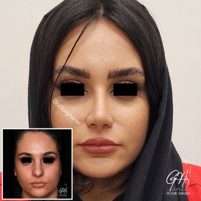 rhinoplasty-before-after-4