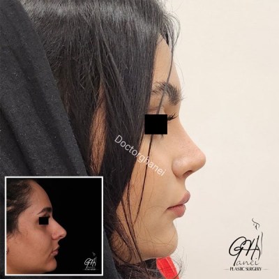 rhinoplasty-before-after-5