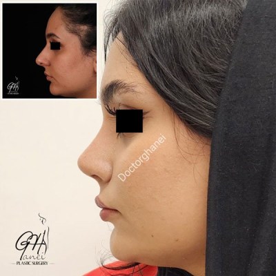 rhinoplasty-before-after-6