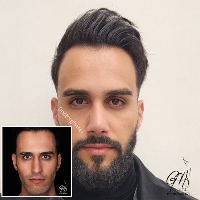 rhinoplasty-before-after-7
