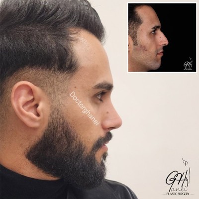 rhinoplasty-before-after-8