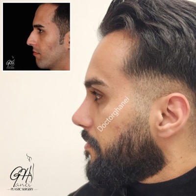 rhinoplasty-before-after-9