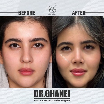 rhinoplasty38