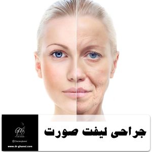 جراحی لیفت صورت