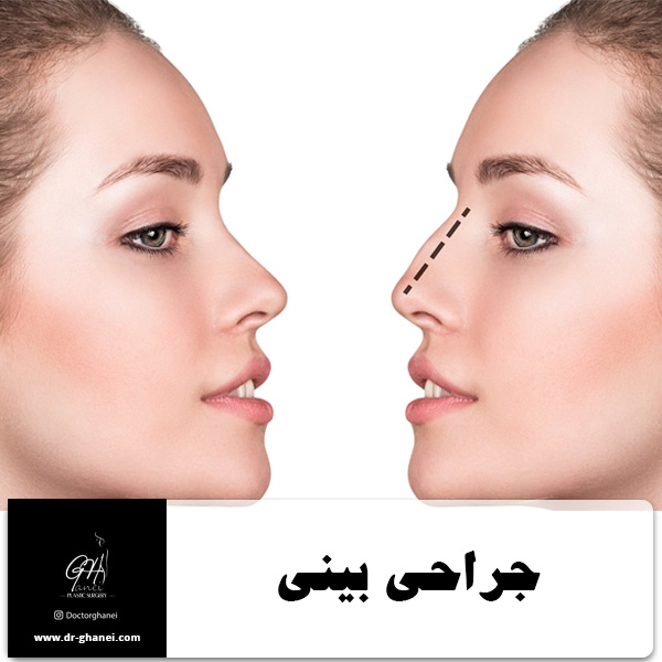 جراحی بینی