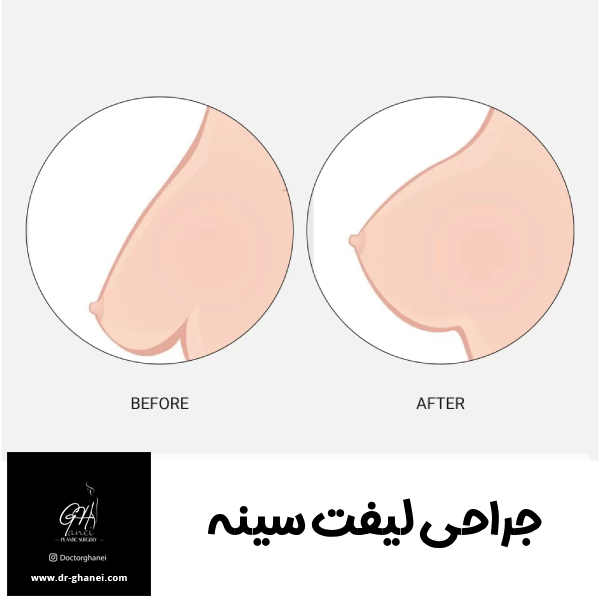 جراحی لیفت سینه - دکتر قانعی