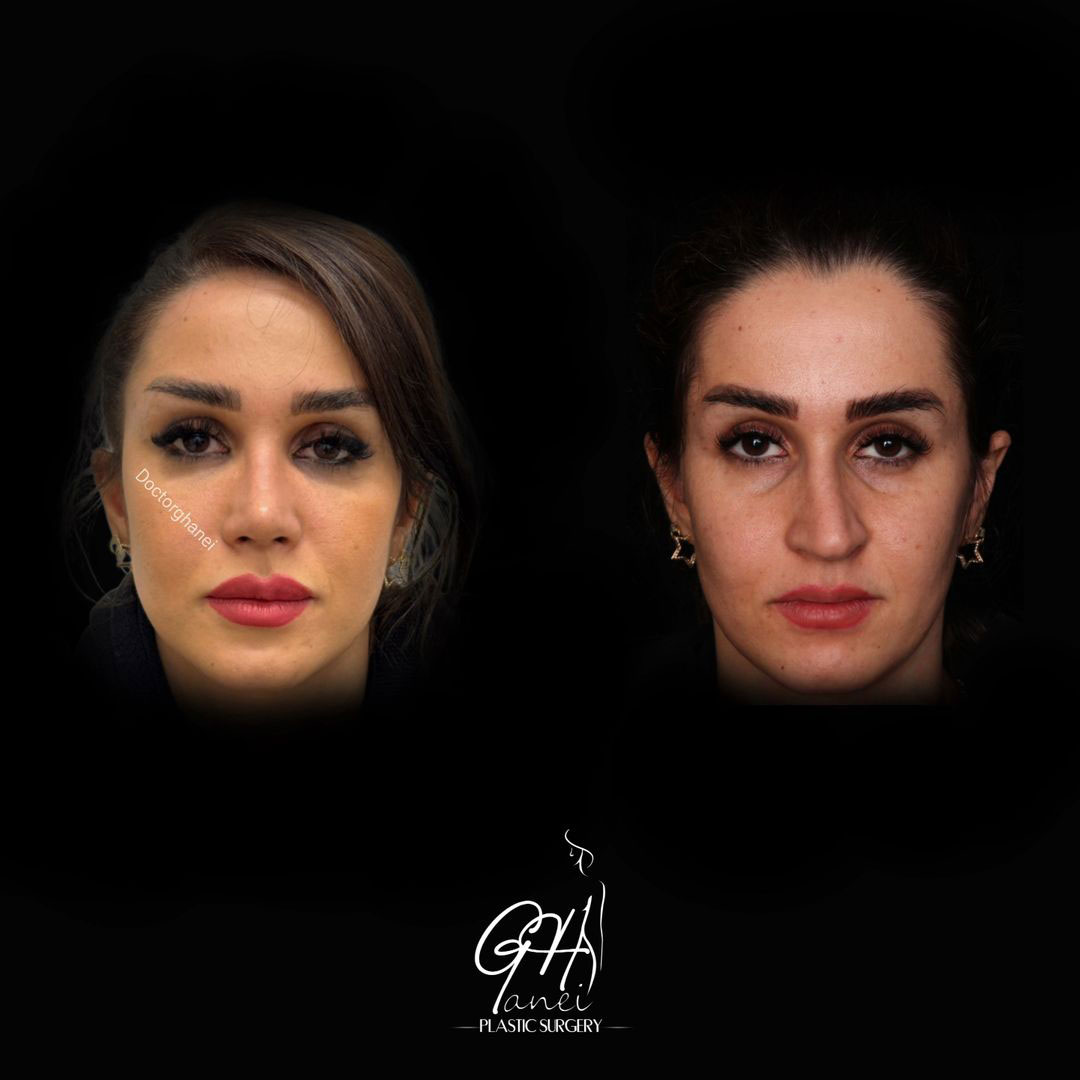 قبل و بعد از جراحی بینی استخوانی به سبک نیمه عروسکی