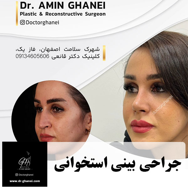 جراحی بینی استخوانی در اصفهان