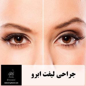 جراحی لیفت ابرو