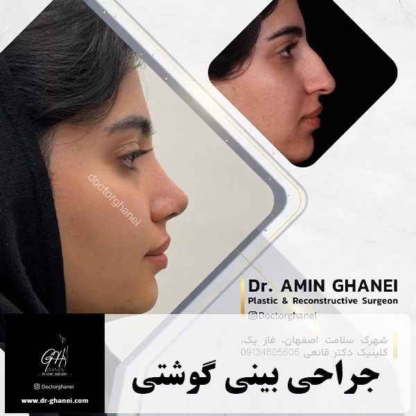 جراحی بینی گوشتی