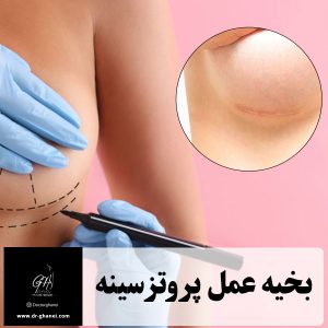بخیه عمل پروتز سینه