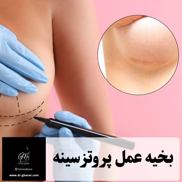 بخیه عمل پروتز سینه