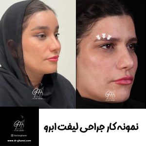 لیفت ابرو با بهترین جراح لیفت ابرو اصفهان - دکتر قانعی