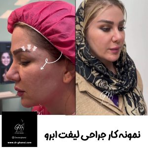 لیفت ابرو با بهترین جراح لیفت ابرو اصفهان - دکتر قانعی