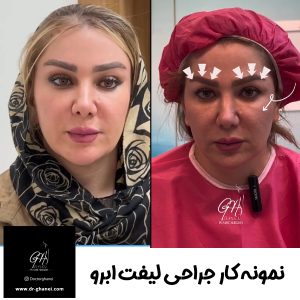 لیفت ابرو با بهترین جراح لیفت ابرو اصفهان - دکتر قانعی
