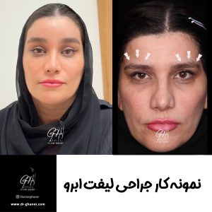 لیفت ابرو با بهترین جراح لیفت ابرو اصفهان - دکتر قانعی