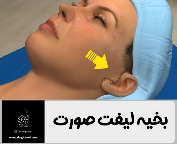 بخیه های لیفت صورت - دکتر امین قانعی 